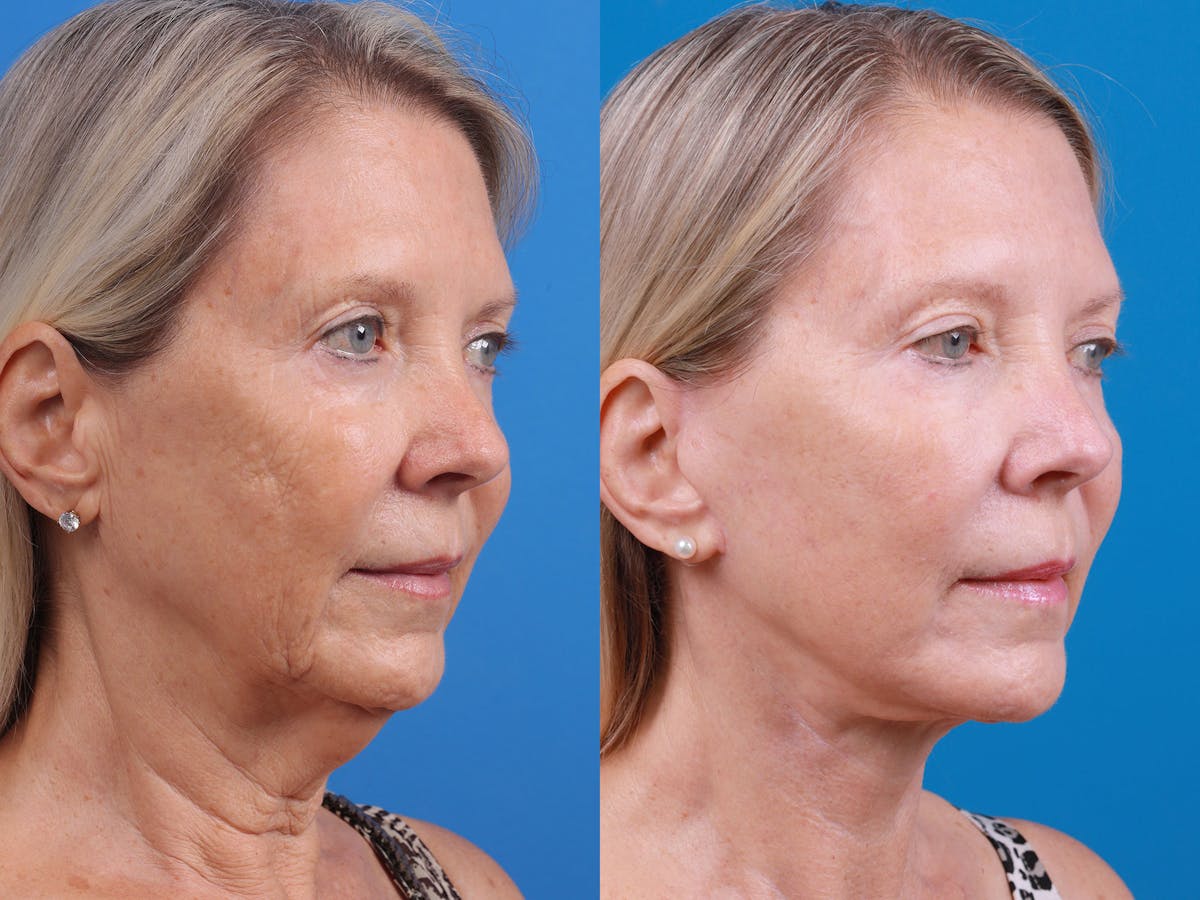 Facelift Before & After Gallery - Patient 163001391 - Image 4
