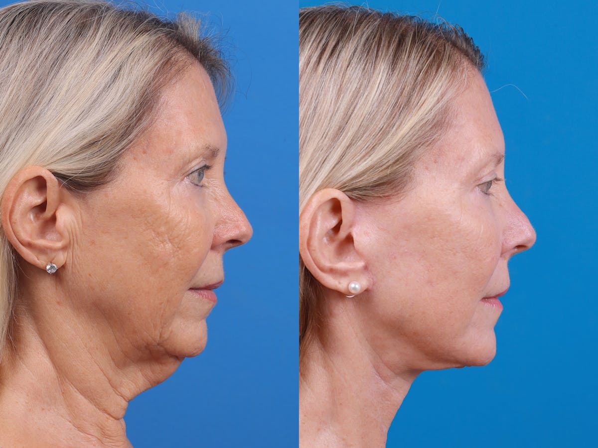 Facelift Before & After Gallery - Patient 163001391 - Image 5