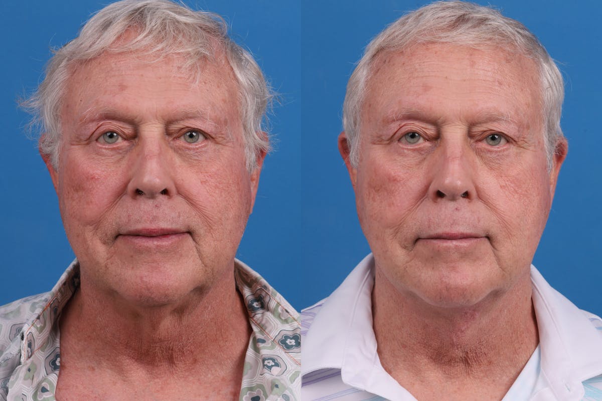 Profile Neck Lift Before & After Gallery - Patient 174011724 - Image 1