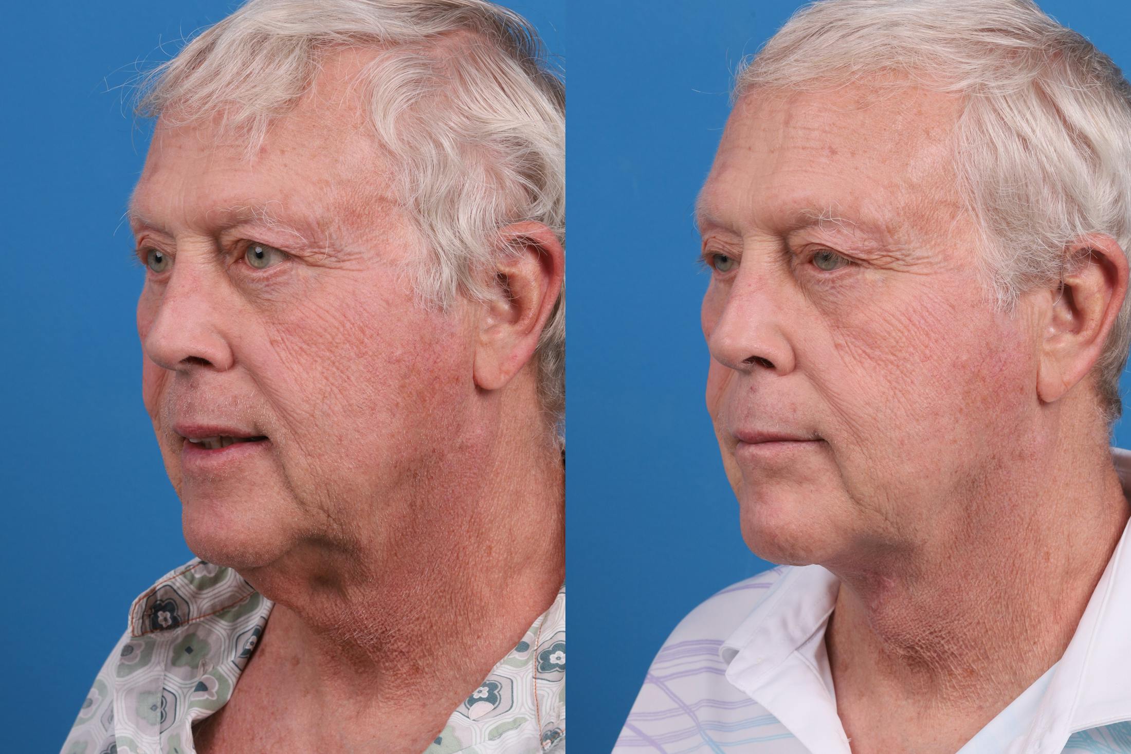 Profile Neck Lift Before & After Gallery - Patient 174011724 - Image 2