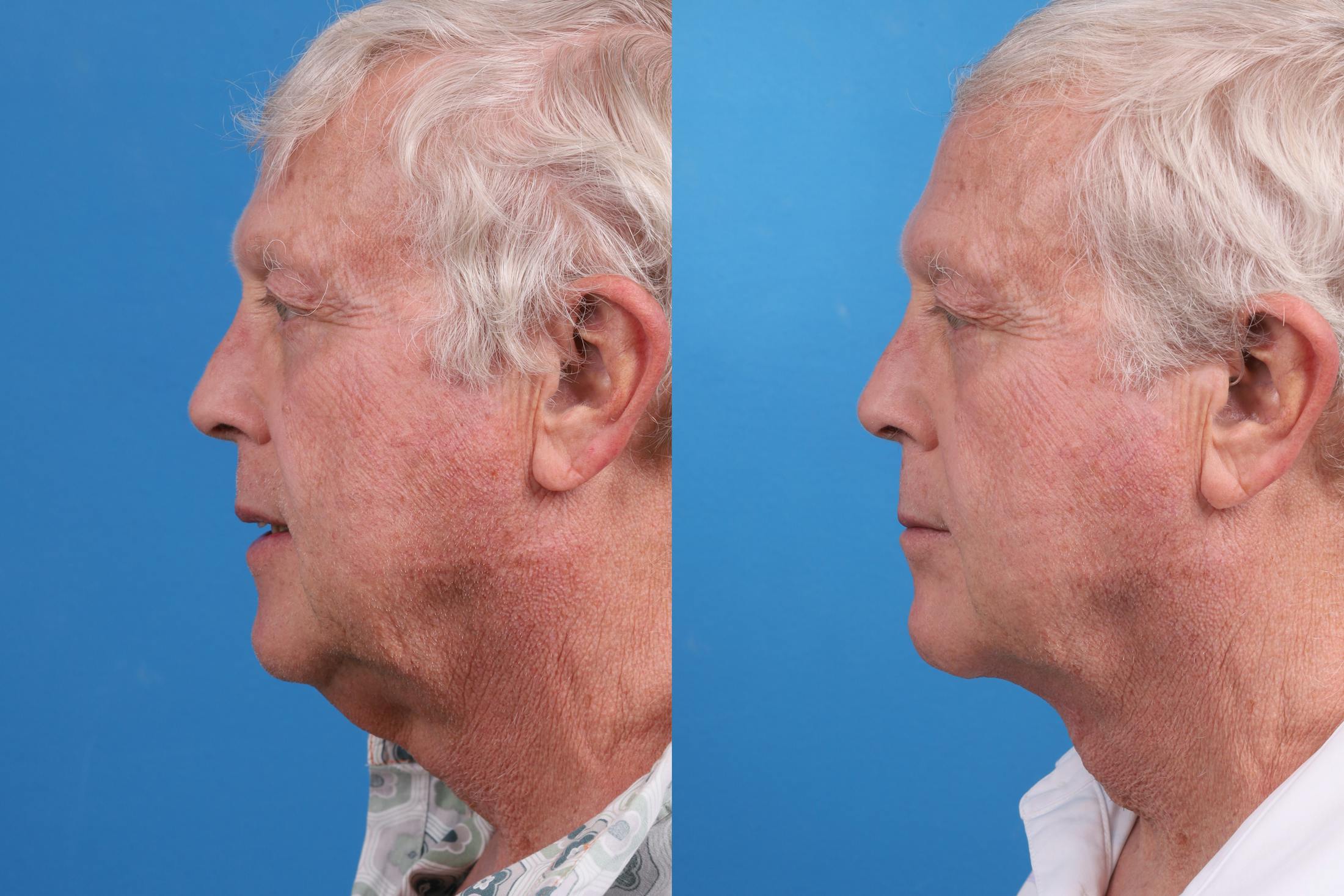 Profile Neck Lift Before & After Gallery - Patient 174011724 - Image 3