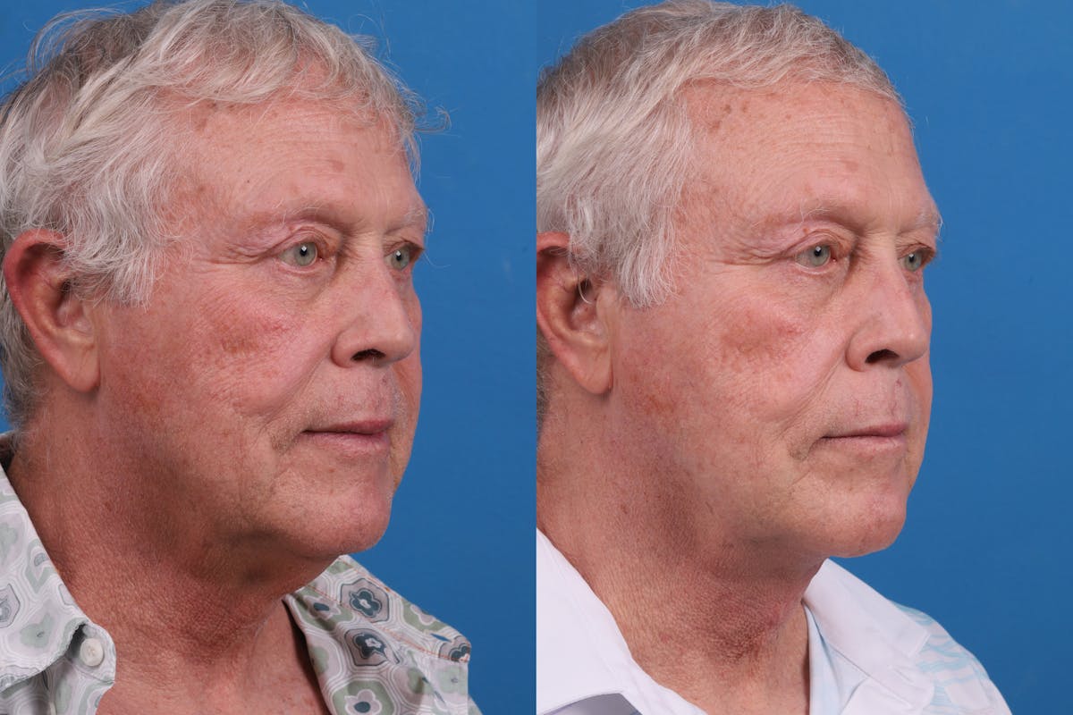 Profile Neck Lift Before & After Gallery - Patient 174011724 - Image 4