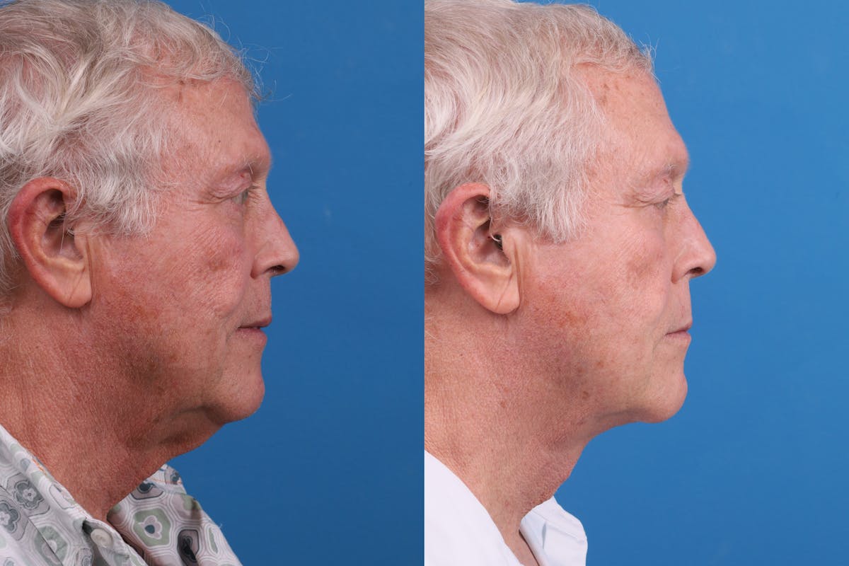 Profile Neck Lift Before & After Gallery - Patient 174011724 - Image 5