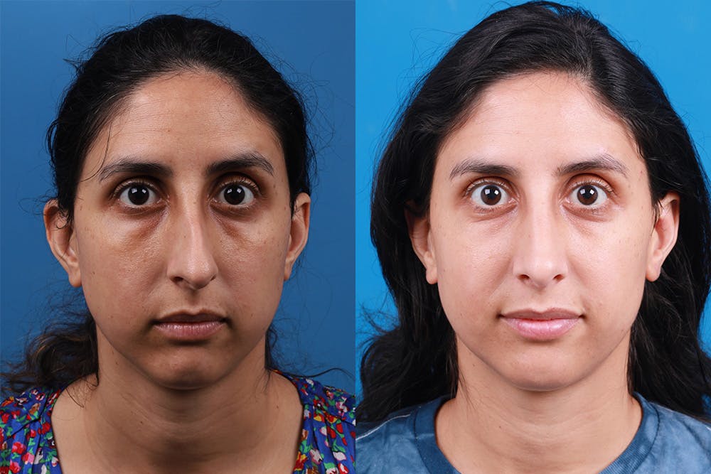 Rhinoplasty Before & After Gallery - Patient 174020983 - Image 1