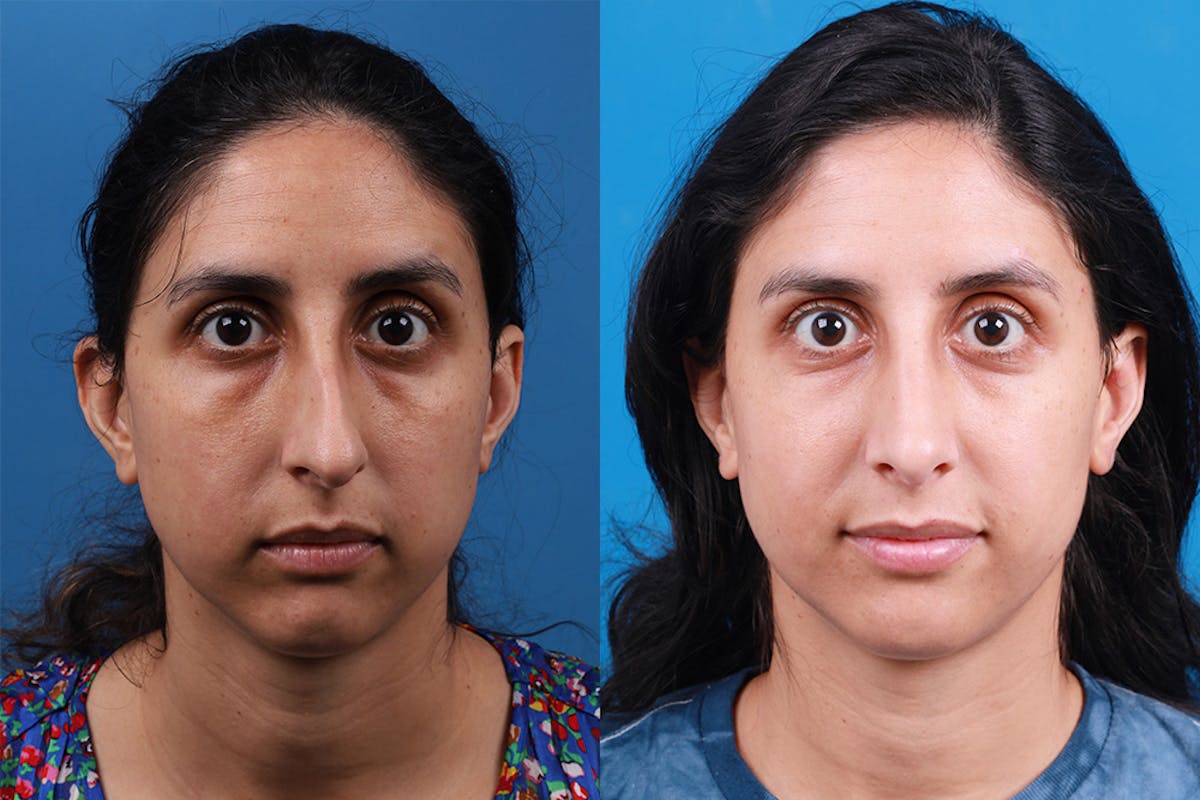 Rhinoplasty Before & After Gallery - Patient 174020983 - Image 1