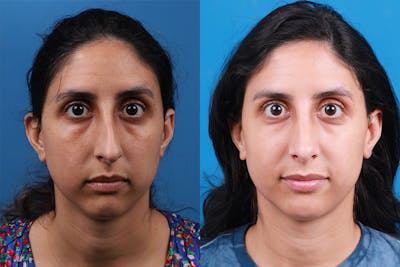 Rhinoplasty Before & After Gallery - Patient 174020983 - Image 1