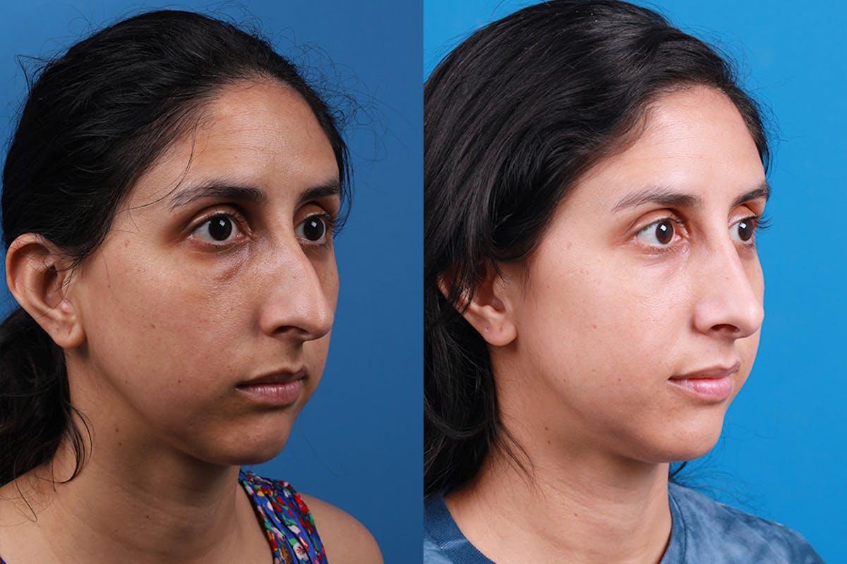 Rhinoplasty Before & After Gallery - Patient 174020983 - Image 2