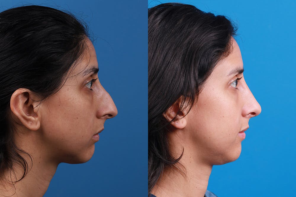 Rhinoplasty Before & After Gallery - Patient 174020983 - Image 3