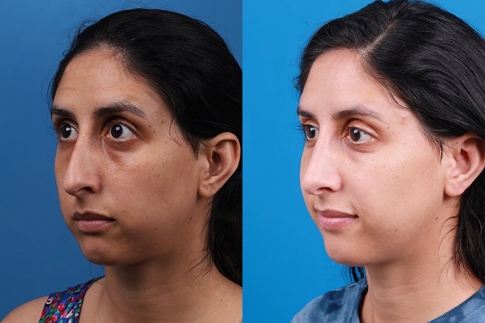 Rhinoplasty Before & After Gallery - Patient 174020983 - Image 4