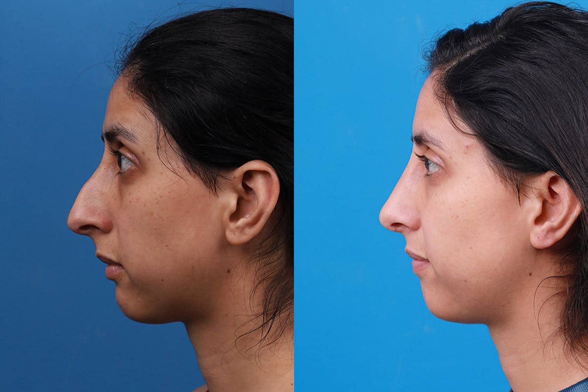 Rhinoplasty Before & After Gallery - Patient 174020983 - Image 5