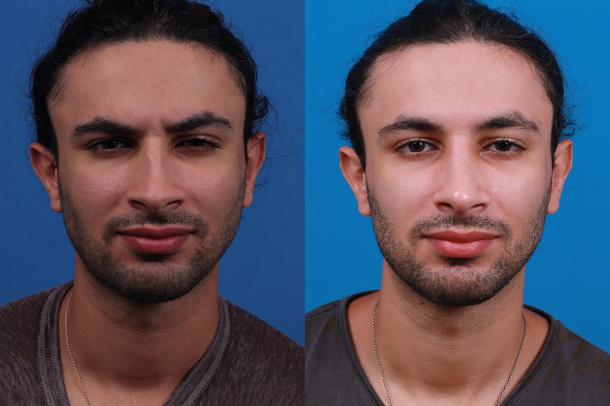 Rhinoplasty Before & After Gallery - Patient 179166674 - Image 1