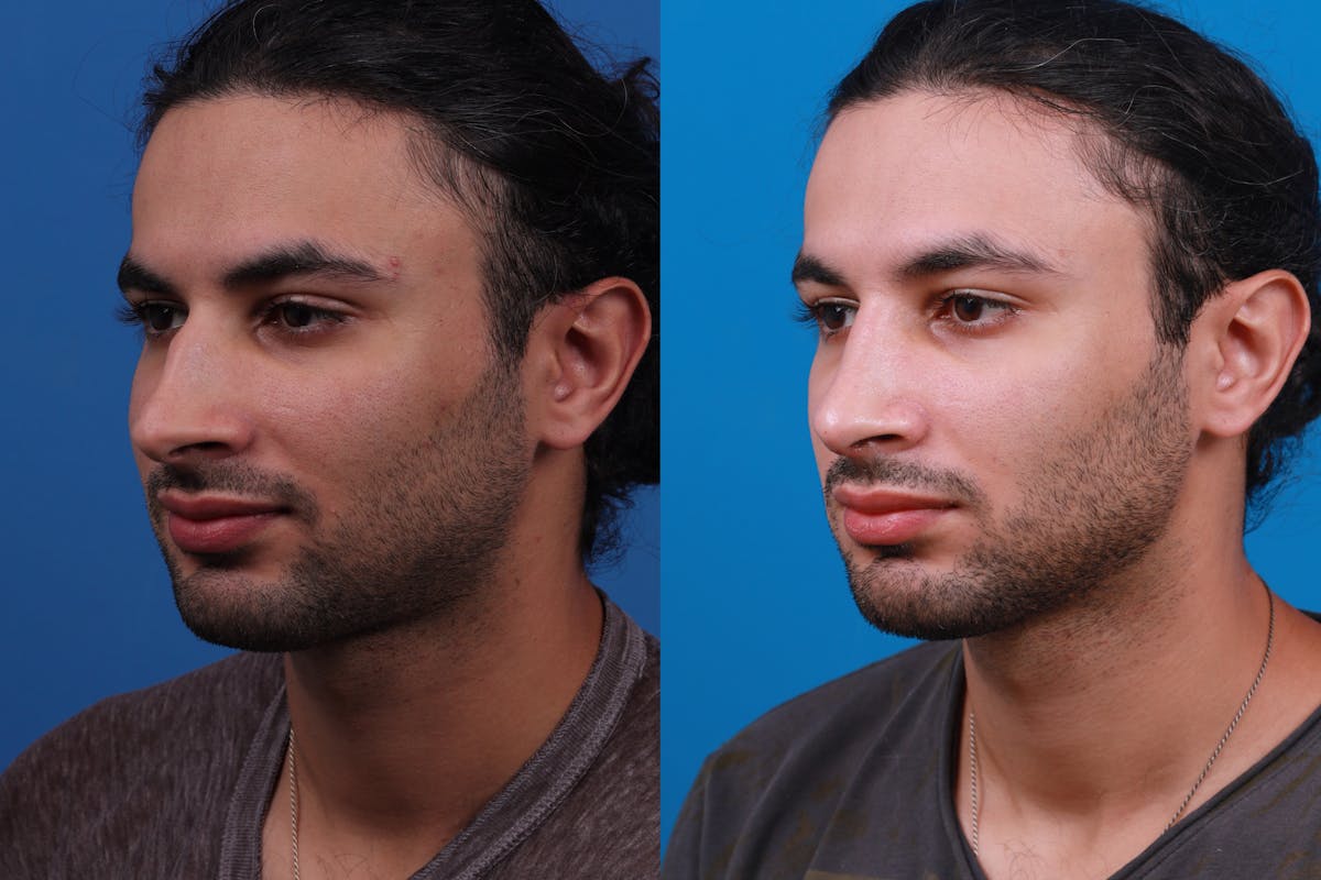 Rhinoplasty Before & After Gallery - Patient 179166674 - Image 2