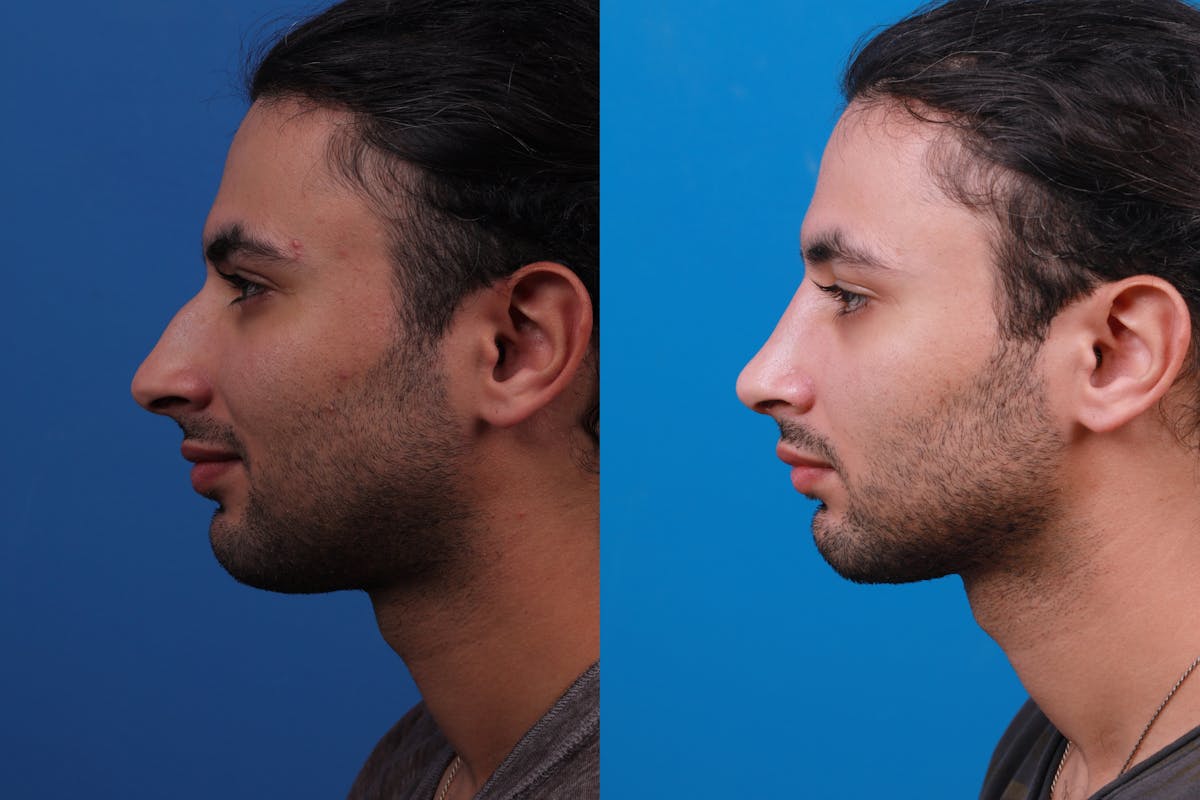 Rhinoplasty Before & After Gallery - Patient 179166674 - Image 3