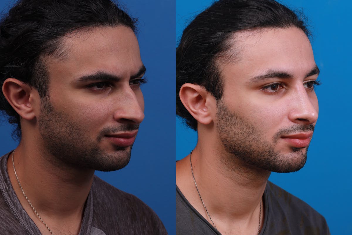 Rhinoplasty Before & After Gallery - Patient 179166674 - Image 4