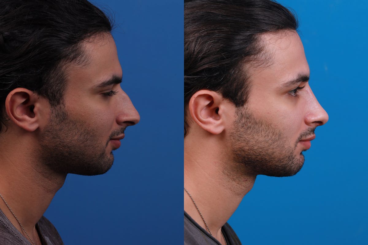 Rhinoplasty Before & After Gallery - Patient 179166674 - Image 5