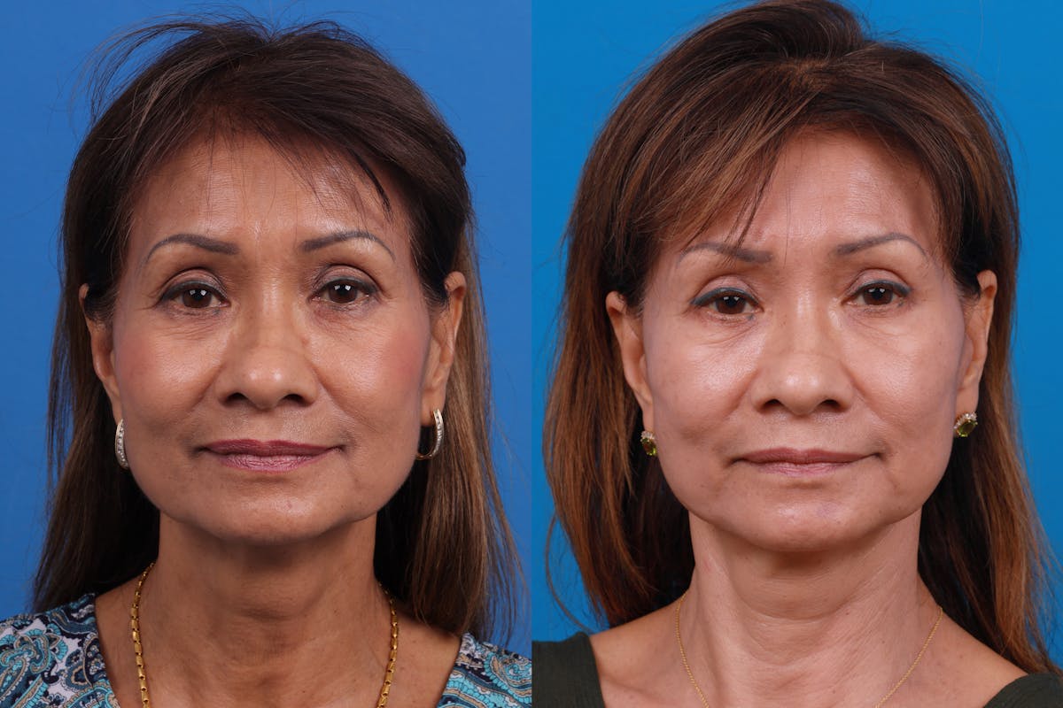 Eyelid Surgery Before & After Gallery - Patient 179167500 - Image 1