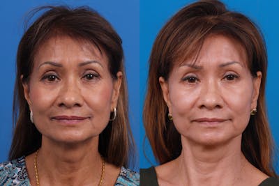 Brow Lift Before & After Gallery - Patient 179167531 - Image 1