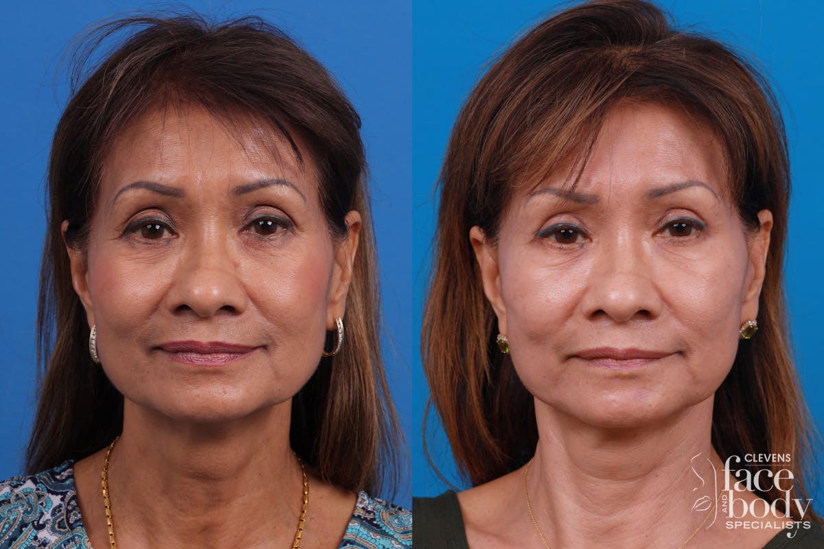 Eyelid Surgery Before & After Gallery - Patient 334524 - Image 1