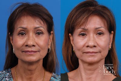 Eyelid Surgery Before & After Gallery - Patient 334524 - Image 1