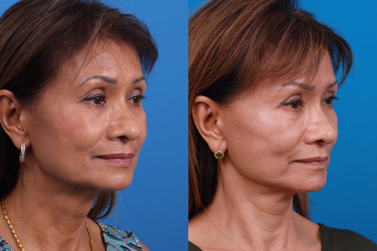 Eyelid Surgery Before & After Gallery - Patient 179167500 - Image 2