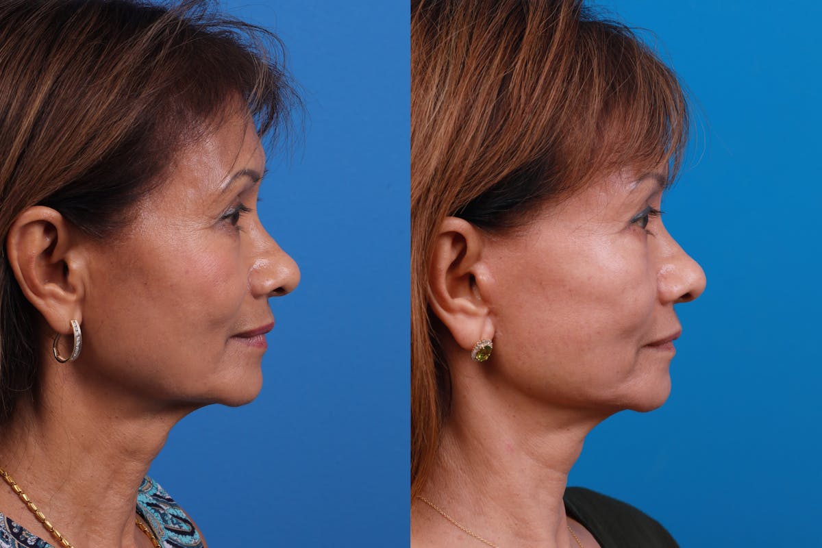Eyelid Surgery Before & After Gallery - Patient 179167500 - Image 3