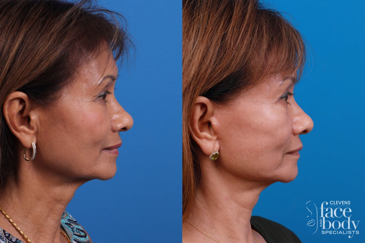 Eyelid Surgery Before & After Gallery - Patient 334524 - Image 3