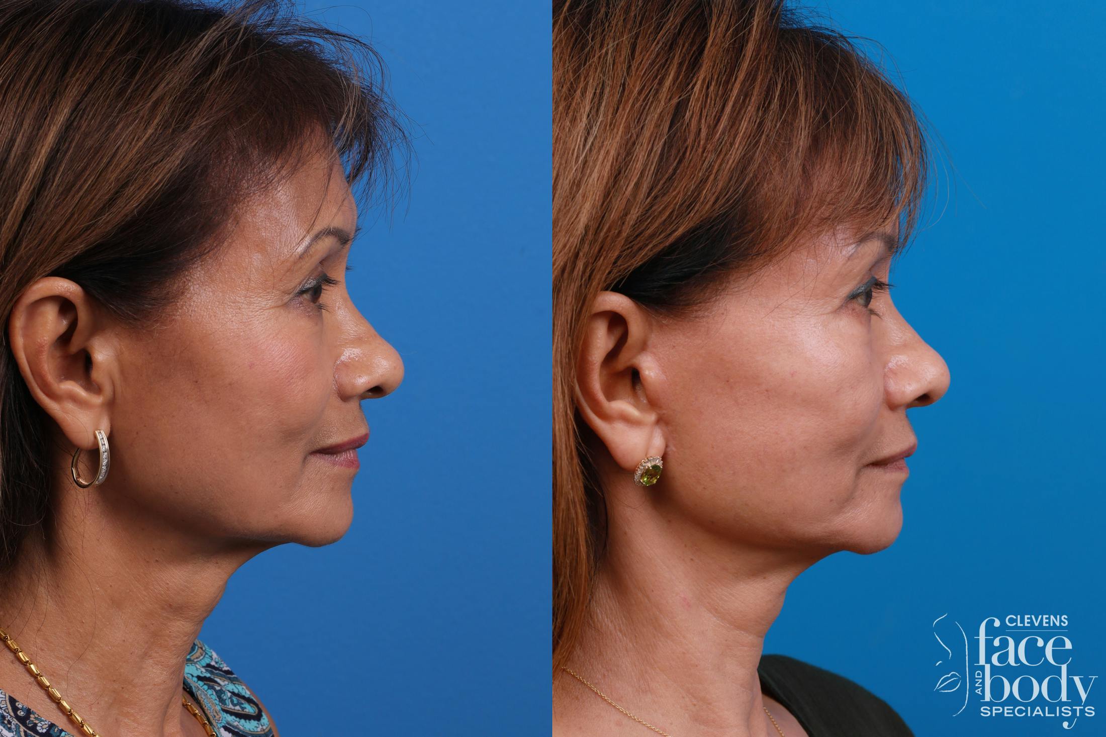 Eyelid Surgery Before & After Gallery - Patient 334524 - Image 3