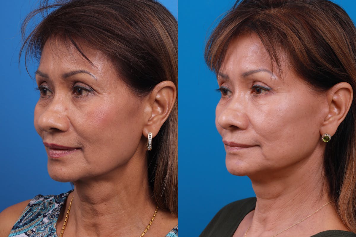 Eyelid Surgery Before & After Gallery - Patient 179167500 - Image 4