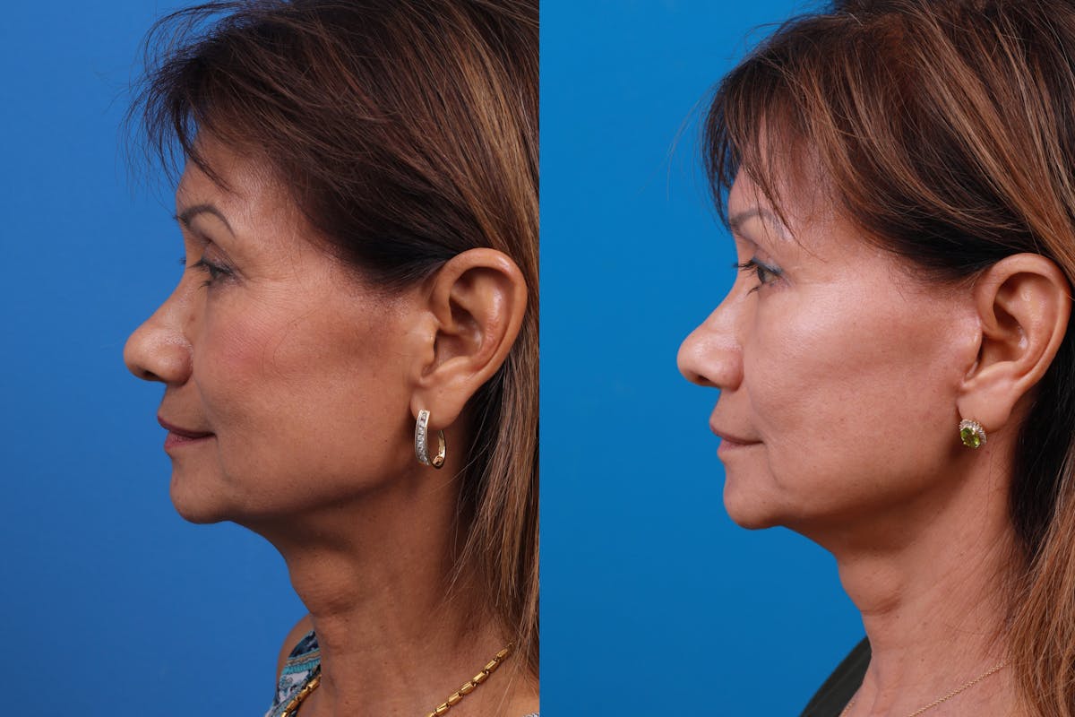 Eyelid Surgery Before & After Gallery - Patient 179167500 - Image 5