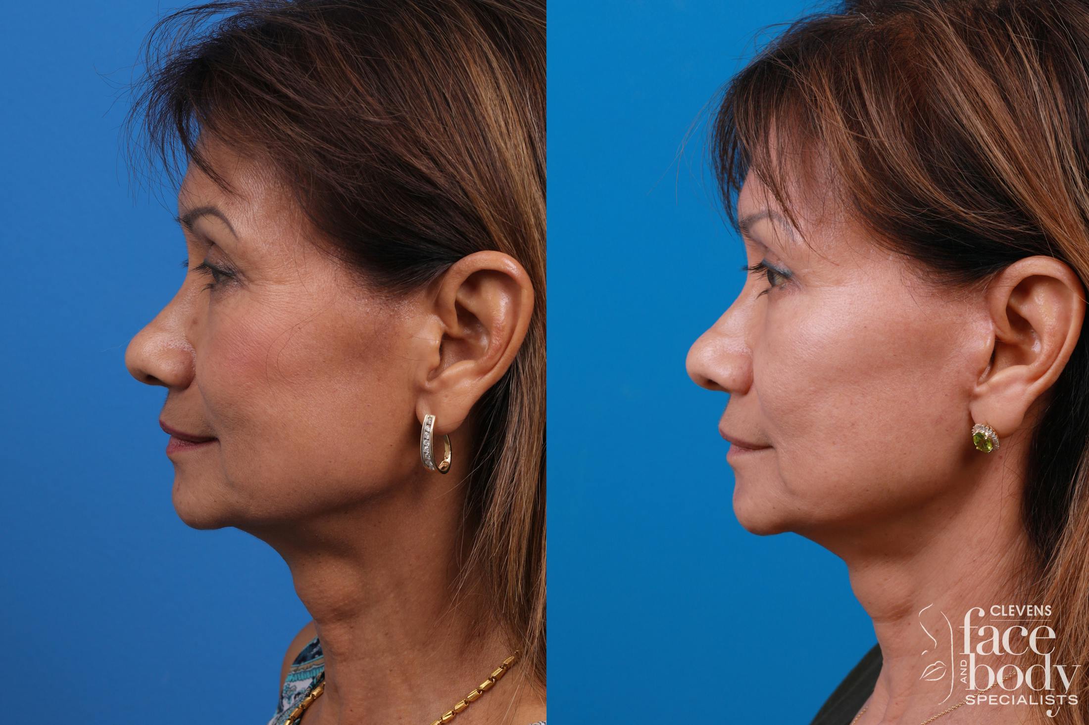 Eyelid Surgery Before & After Gallery - Patient 334524 - Image 5
