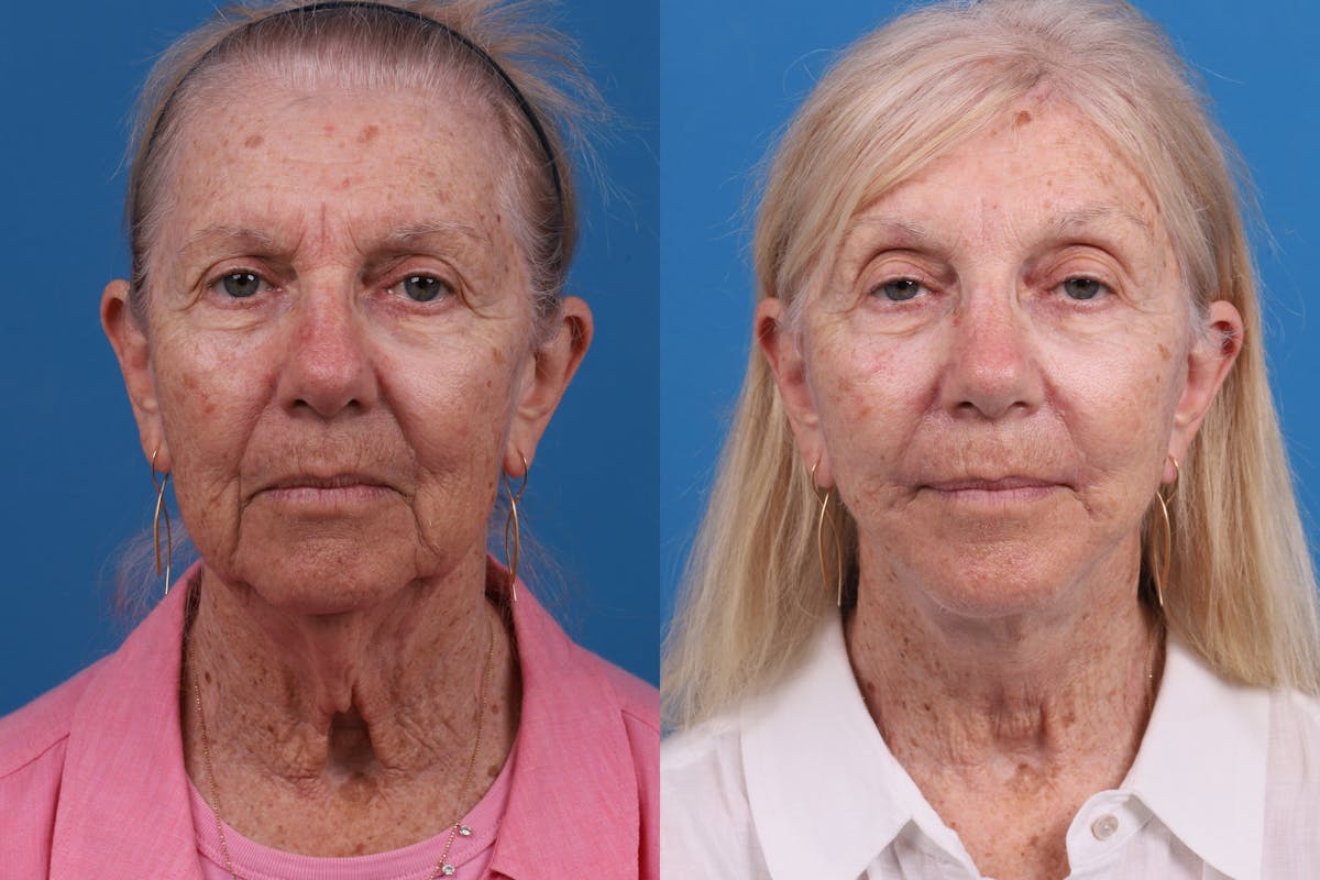 Lip Lift Before & After Gallery - Patient 184320097 - Image 1