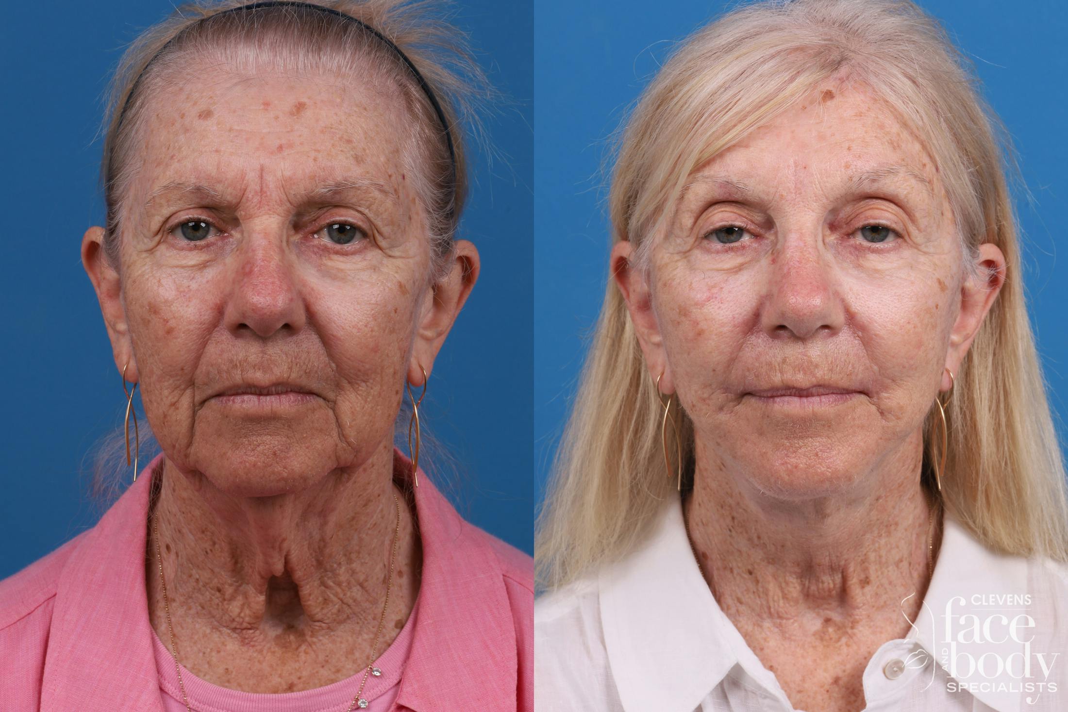 Eyelid Surgery Before & After Gallery - Patient 114776 - Image 1