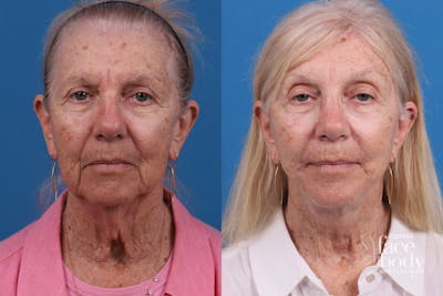 Eyelid Surgery Before & After Gallery - Patient 114776 - Image 1