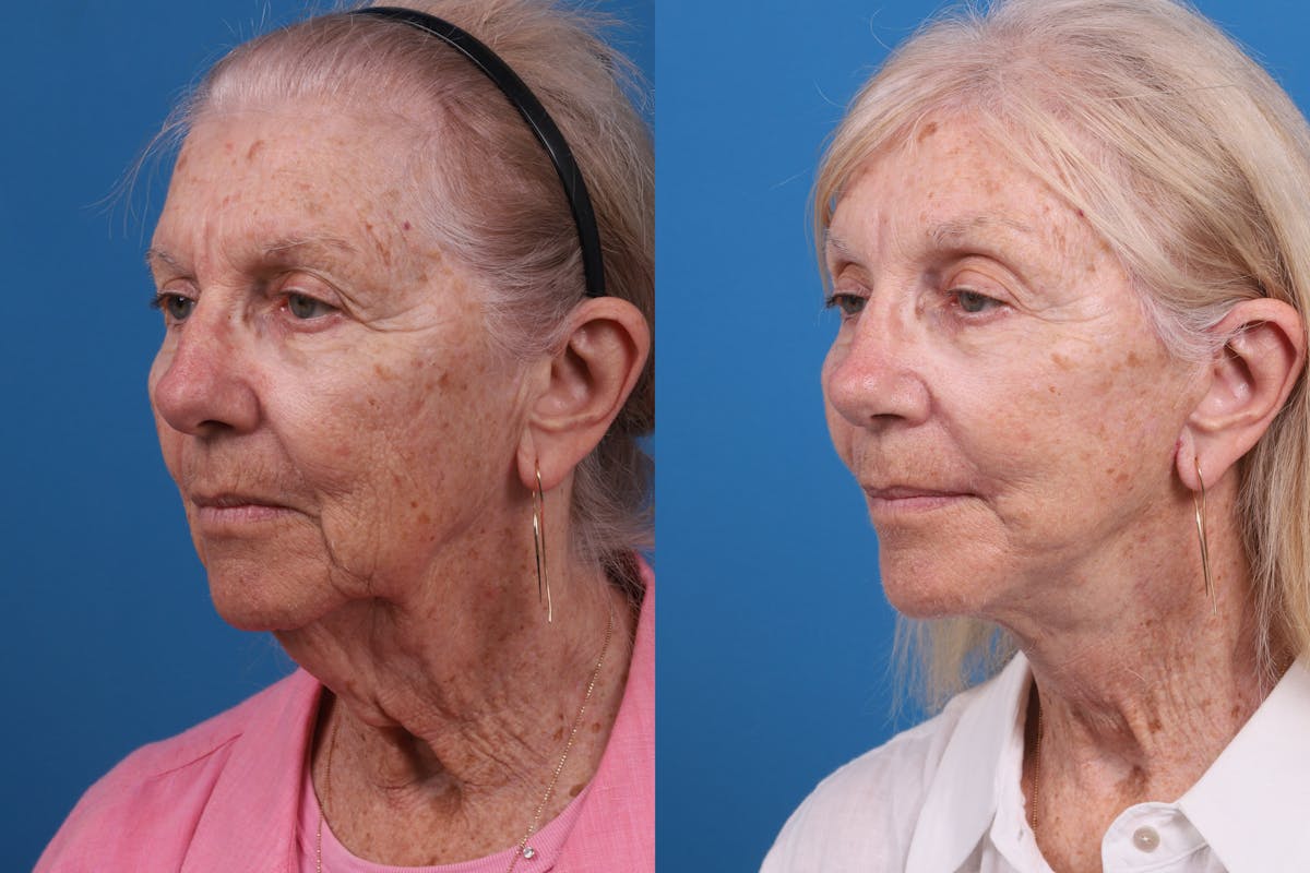 Eyelid Surgery Before & After Gallery - Patient 184320096 - Image 2