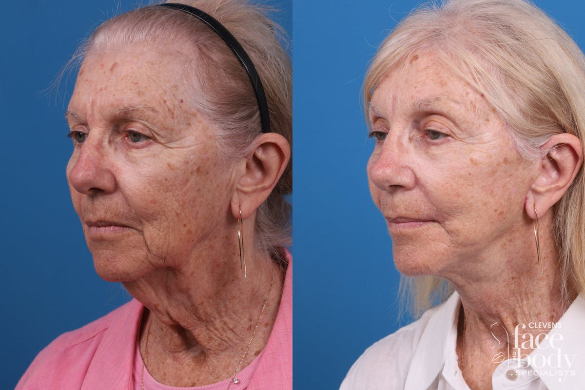 Eyelid Surgery Before & After Gallery - Patient 114776 - Image 2