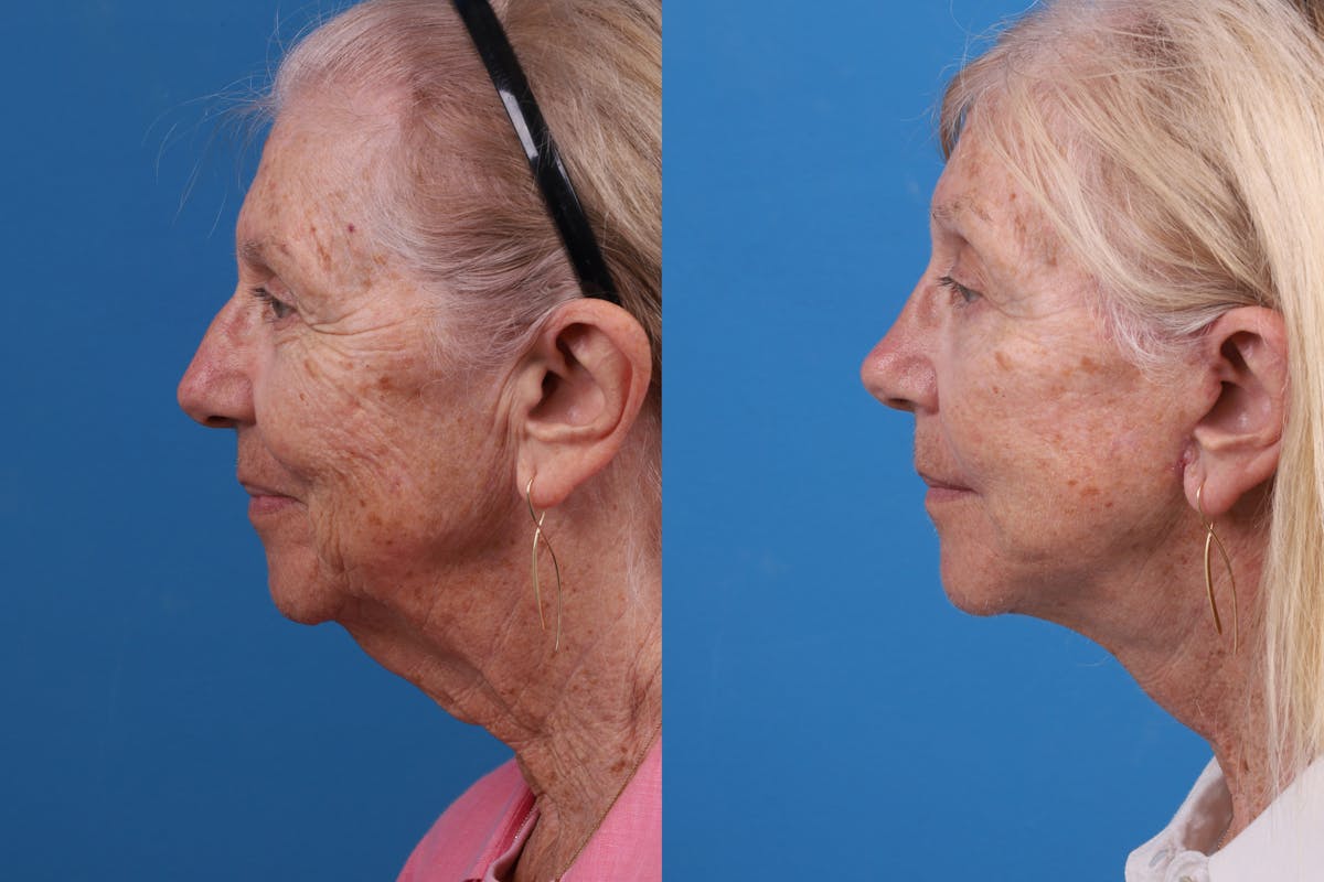 Eyelid Surgery Before & After Gallery - Patient 184320096 - Image 3