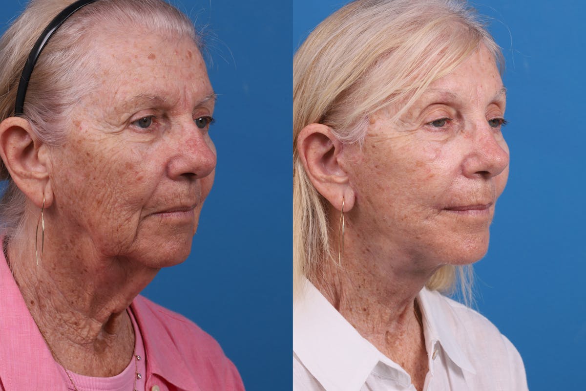 Brow Lift Before & After Gallery - Patient 184320093 - Image 4