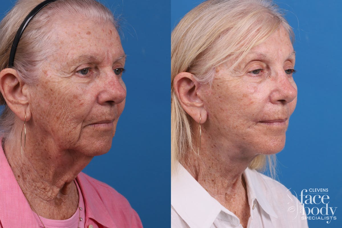 Eyelid Surgery Before & After Gallery - Patient 114776 - Image 4