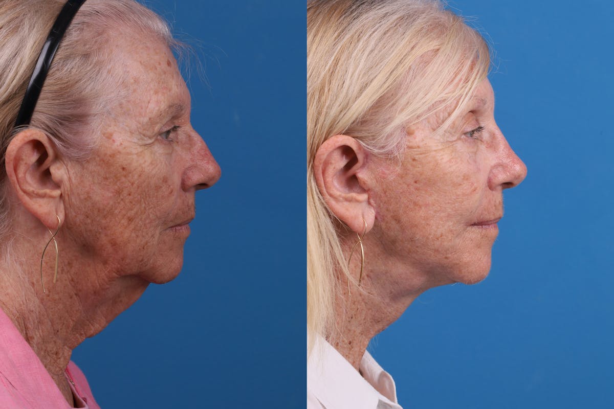 Facelift Before & After Gallery - Patient 184320091 - Image 5