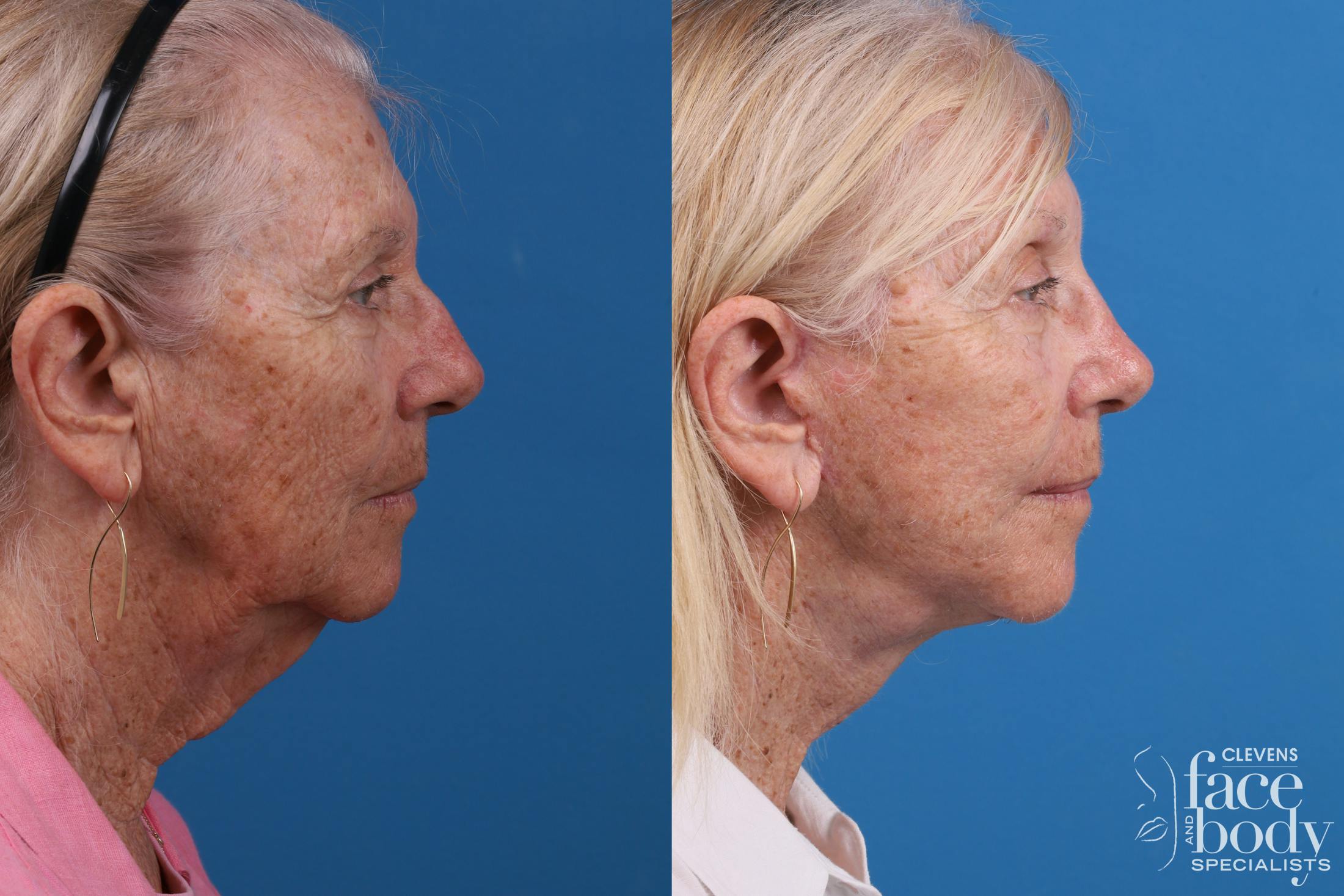Eyelid Surgery Before & After Gallery - Patient 114776 - Image 5