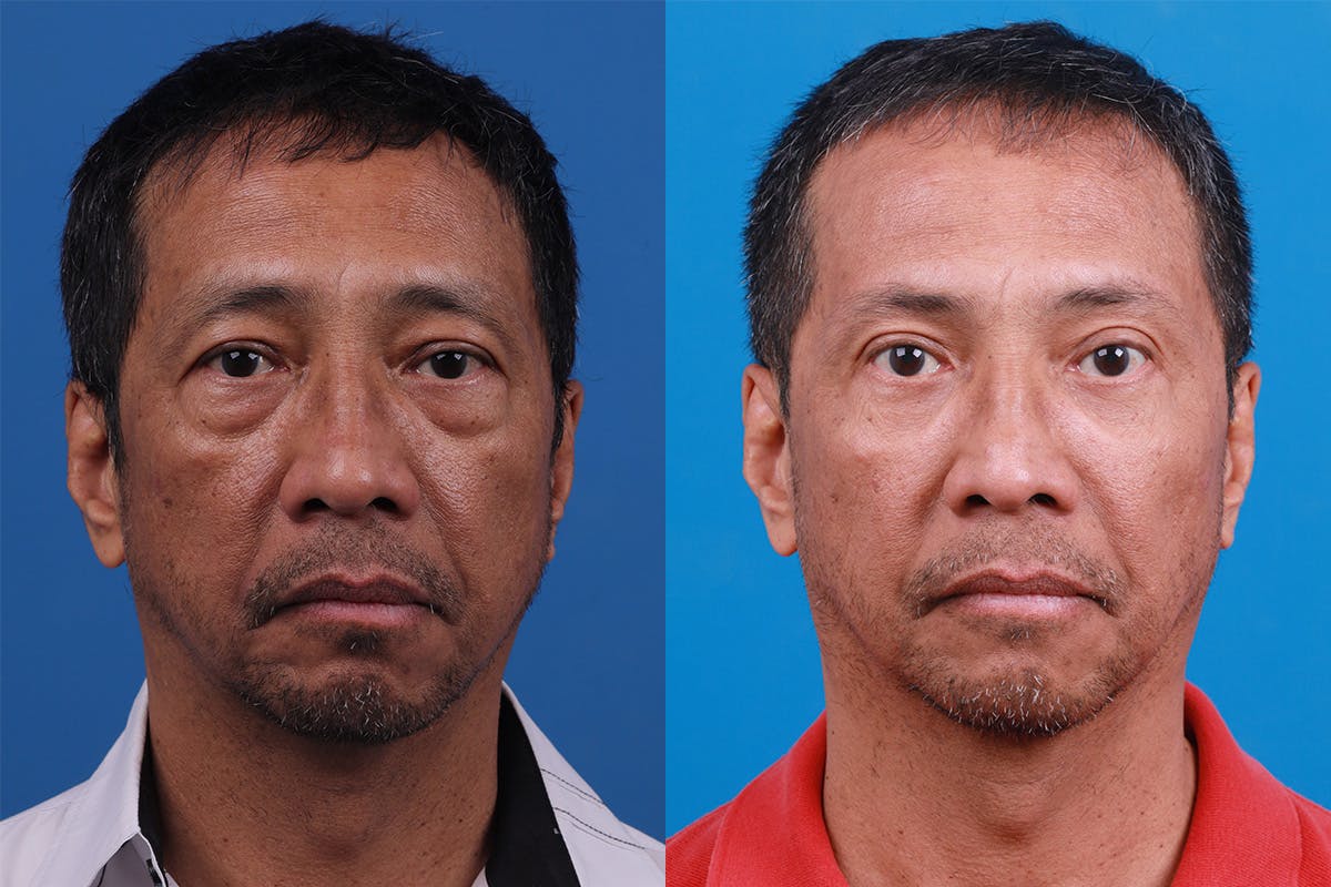 Eyelid Surgery Before & After Gallery - Patient 184320244 - Image 1