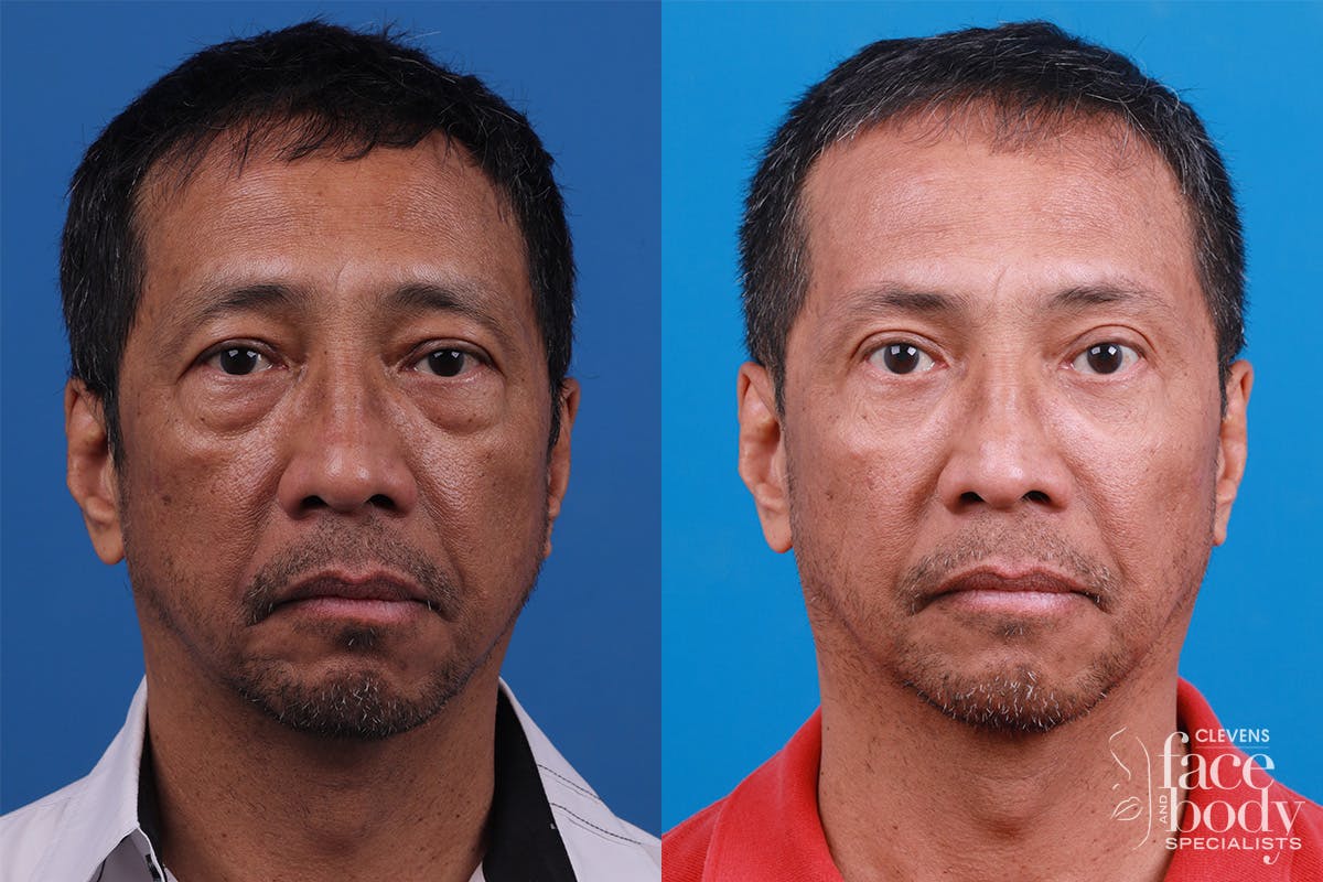 Eyelid Surgery Before & After Gallery - Patient 112478 - Image 1