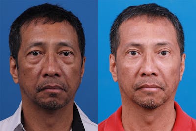 Eyelid Surgery Before & After Gallery - Patient 184320244 - Image 1