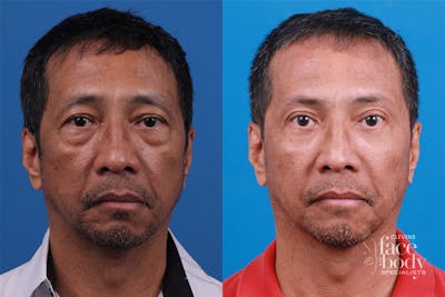 Eyelid Surgery Before & After Gallery - Patient 112478 - Image 1
