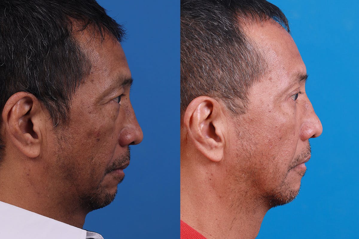 Dermal Fillers Before & After Gallery - Patient 184320289 - Image 3