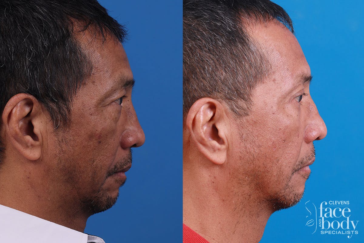 Eyelid Surgery Before & After Gallery - Patient 112478 - Image 3