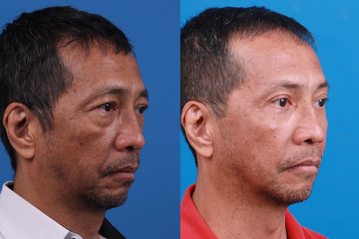 Eyelid Surgery Before & After Gallery - Patient 184320244 - Image 2