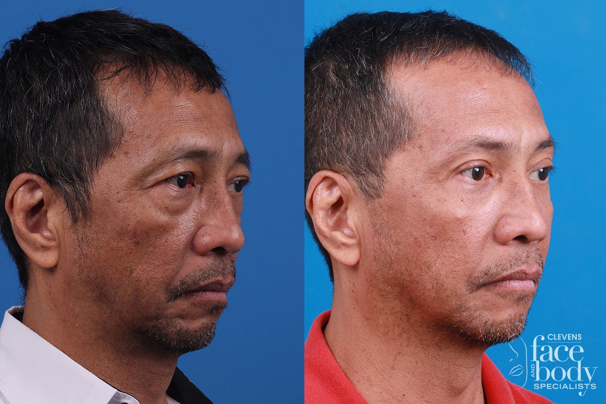 Eyelid Surgery Before & After Gallery - Patient 112478 - Image 2
