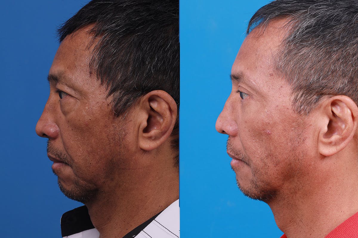 Dermal Fillers Before & After Gallery - Patient 184320289 - Image 5