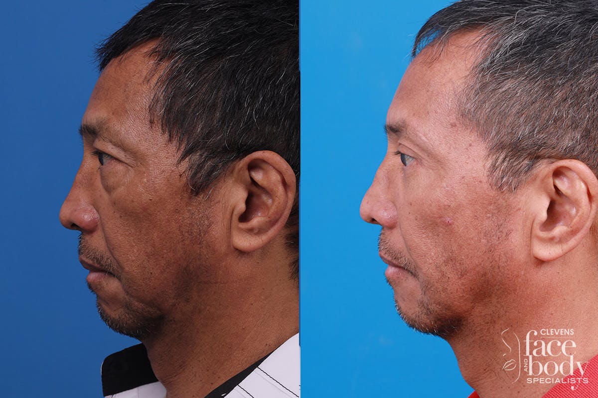 Eyelid Surgery Before & After Gallery - Patient 112478 - Image 5